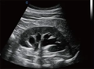 Клинические изображения УЗИ аппарат Chison SonoTouch 80 Pro портативный