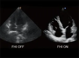 Клинические изображения УЗИ аппарат Chison SonoTouch 80 Pro портативный