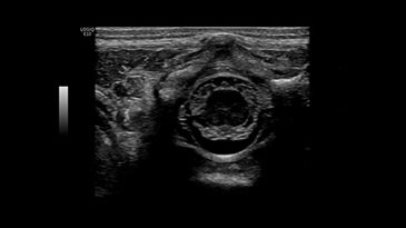 Клинические изображения GE HealthCare Logiq E10 ультразвуковая система