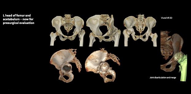 КТ костей таза