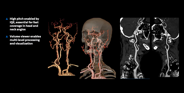КТ-ангиография головы и шеи