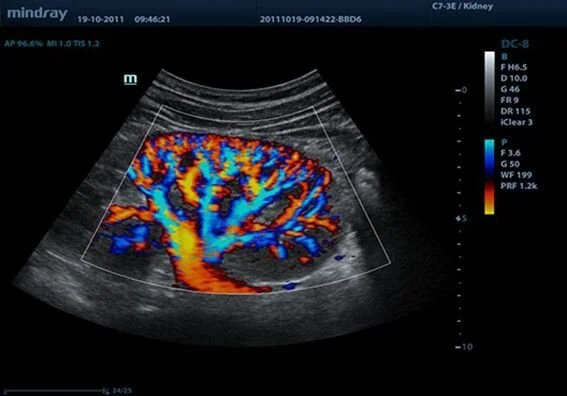 Клинические изображения УЗИ аппарат Mindray DC-8