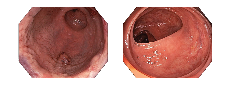 Esophagogastroduodenoscopy-with-Olympus-GIF-HQ190-and-Colonoscopy-with-Olympus-CF-HQ190LI.png