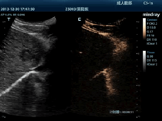 Клинические изображения УЗИ аппарат Mindray M9 портативный